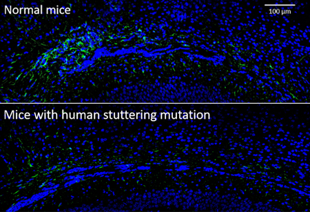 Top panel: A microscopic image of normal mouse brain cells stained in blue. Cells shown in green are astrocytes, a type of support cell in the brain.Bottom panel: A microscopic image showing many fewer green-stained astrocytes in mice engineered with a human stuttering gene.