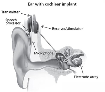 An illustration of an inner ear with a cochlear implant.