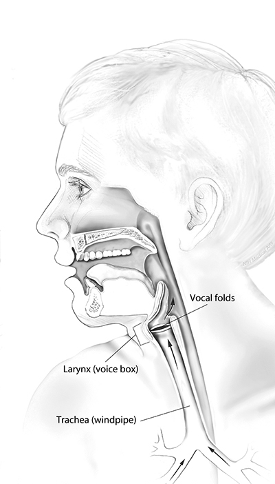 Illustration of the respiratory tract affected by RRP.