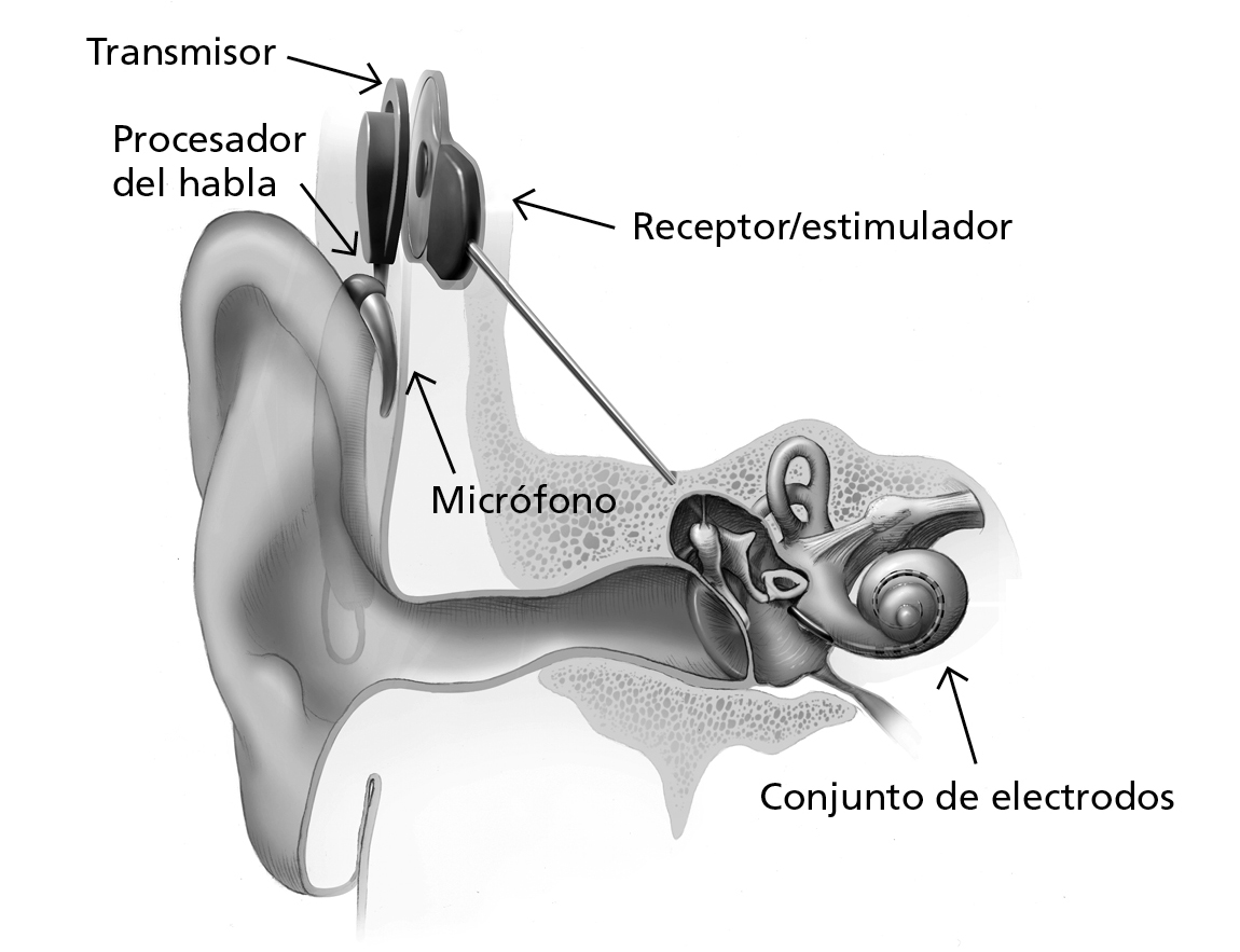 Ilustración del oído interno con un dispositivo de implante coclear. El transmisor está ubicado en la parte exterior del cráneo por encima del oído. Hay un receptor/estimulador en el interior del cráneo al lado del transmisor. Un procesador del habla se encuentra detrás del oído fuera del cráneo. Un conjunto de electrodos está en la cóclea dentro del oído interno.