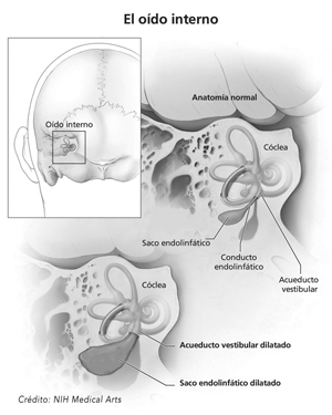 Ilustración de la anatomía del oído interno y su ubicación en el cráneo. Los componentes del oído interno incluyen la cóclea, el saco endolinfático, el conducto endolinfático, y el acueducto vestibular. En la ilustración de cerca se puede ver la ubicación y el tamaño de un acueducto vestibular dilatado y un saco endolinfático dilatado.