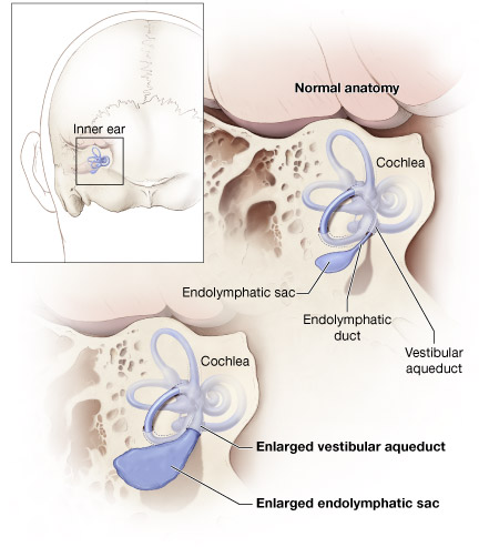 Illustration showing the normal inner ear versus an inner ear with enlarged vestibular aqueduct and enlarged endolymphatic sac