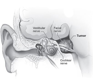Inner ear with vestibular schwannoma (tumor)