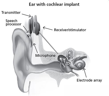 cochlear implant web pic